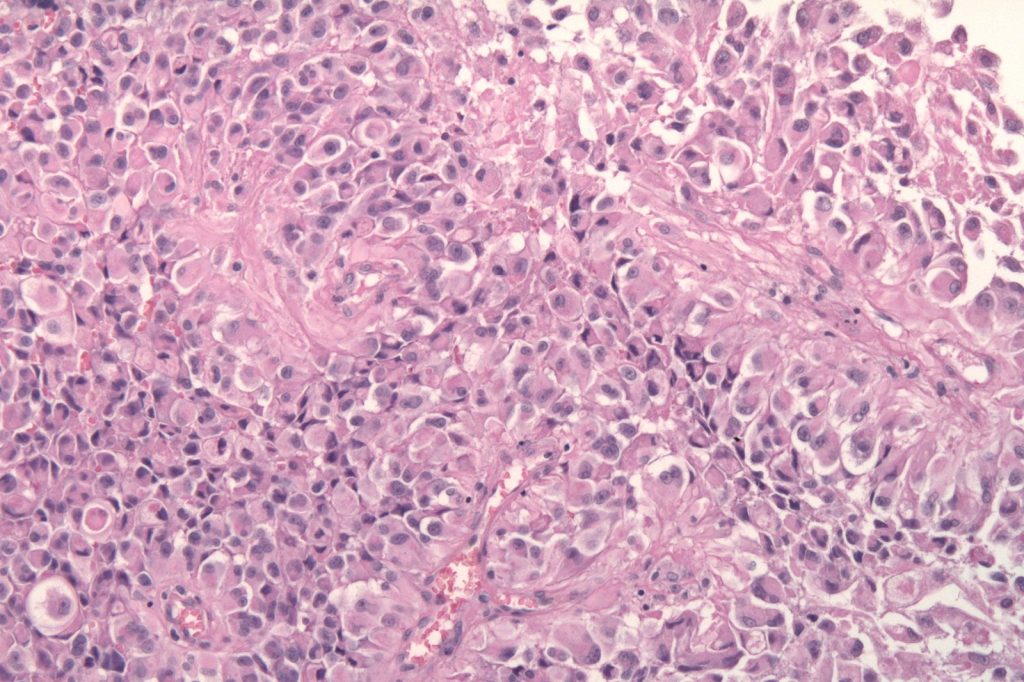Researchers Use Vitamin B12 to Bypass Blood-Brain Barrier in Glioblastoma Fight
