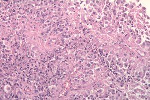 Researchers Use Vitamin B12 to Bypass Blood-Brain Barrier in Glioblastoma Fight