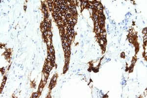 Oncotype DX Testing Cost-Effectiveness Analyzed in US Healthcare