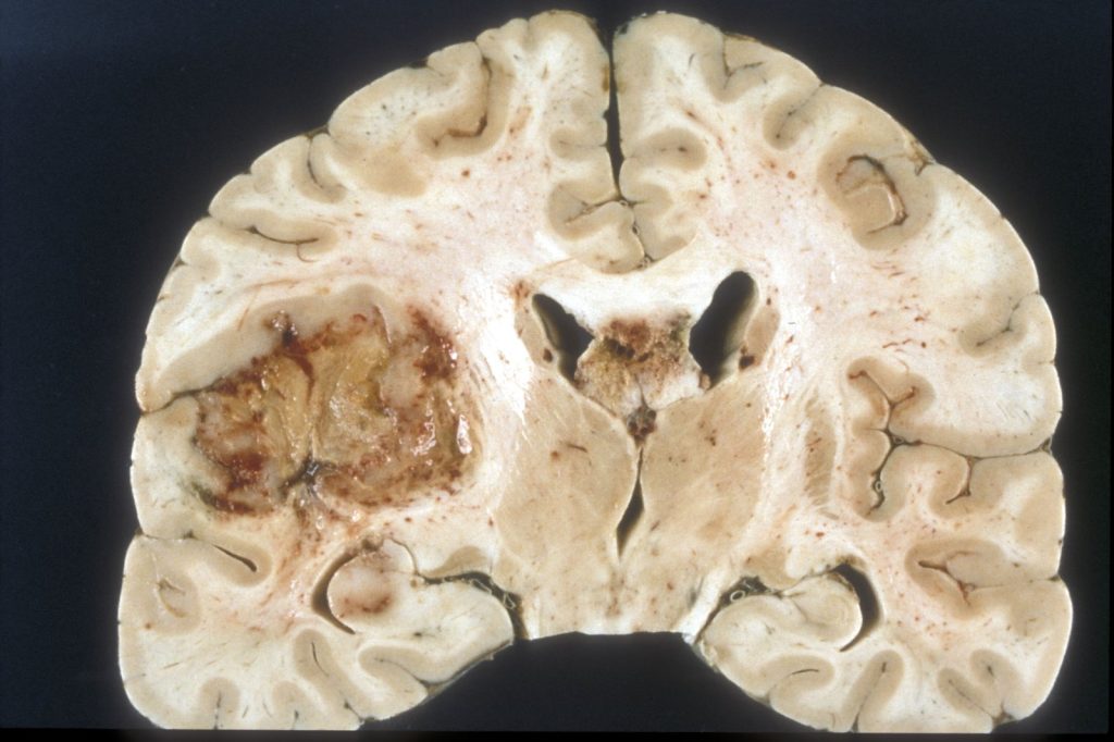 Vitamin B12 Transport System Used to Deliver Glioblastoma Treatment Past Brain Barrier