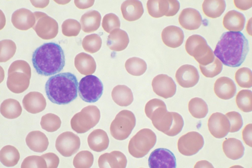 CAR-T Therapy Shows High Response Rates in CLL Trial
