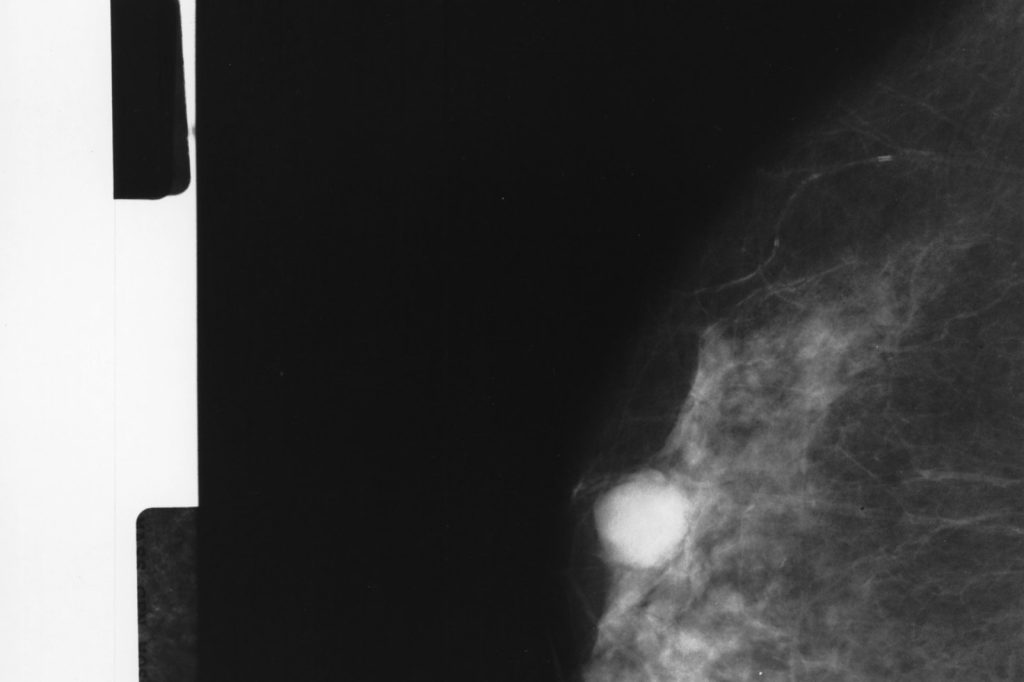 Gene testing gap leaves some UK breast cancer patients at risk