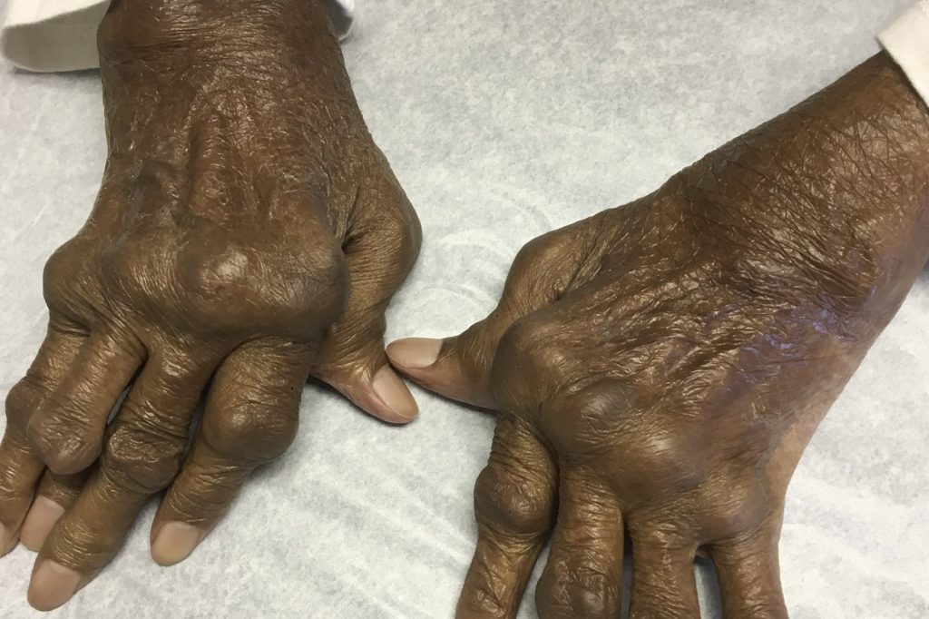 Immune System Malfunctions Cause Autoimmune Diseases, Allergies