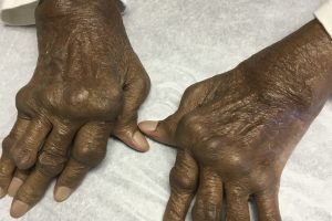 Immune System Malfunctions Cause Autoimmune Diseases, Allergies