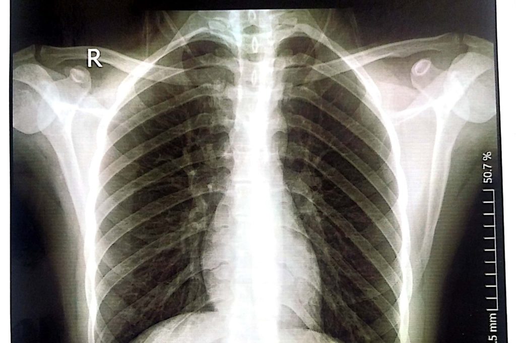 Samuel Mathias chest pains turn out to be rare cancer diagnosis