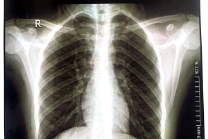 Samuel Mathias’ chest pains turn out to be rare cancer diagnosis