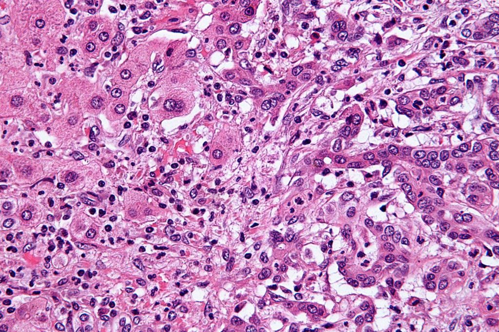 New Targeted Drug Zenocutuzumab Shows Promise for Rare Bile Duct Cancer