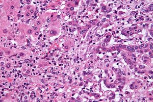 New Targeted Drug Zenocutuzumab Shows Promise for Rare Bile Duct Cancer