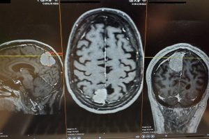 Self-amplifying RNA platform enters brain cancer clinical trial