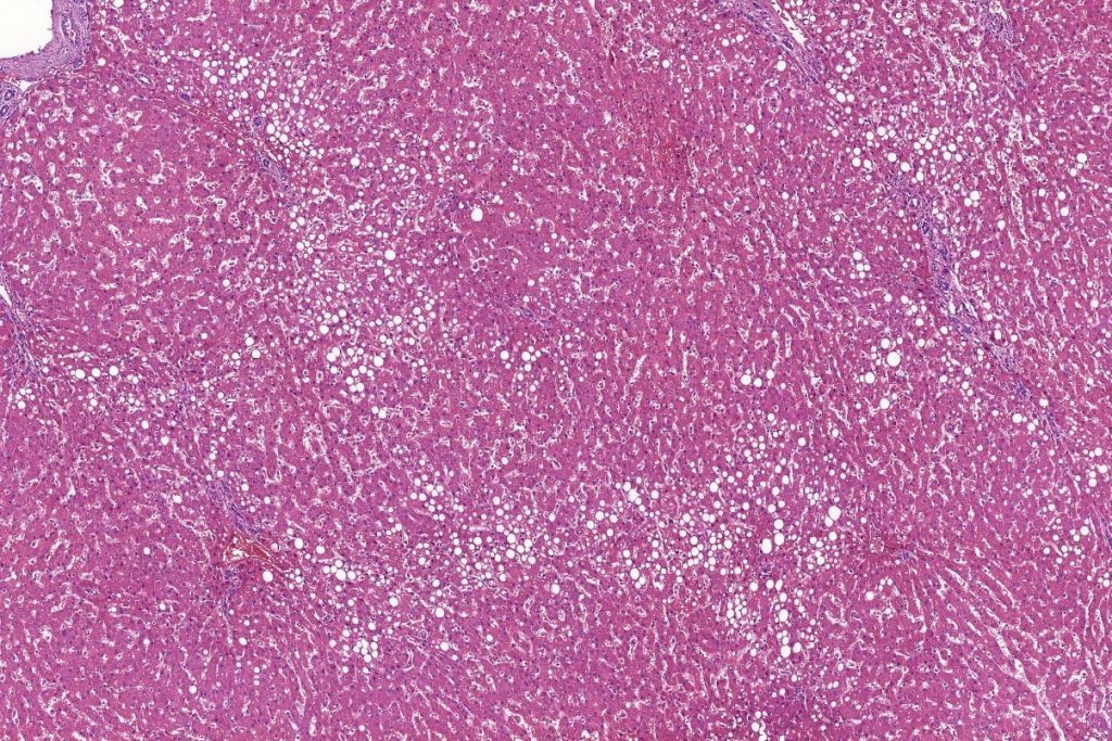 Loss Of GATA6 Protein Enables Colorectal Cancer To Spread To Liver