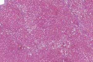 Loss Of GATA6 Protein Enables Colorectal Cancer To Spread To Liver