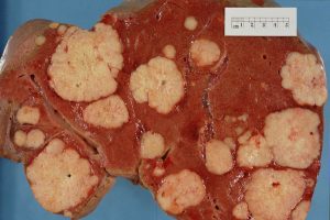Study Reveals Why Immunotherapy Fails for Rare Liver Cancer, Points to Existing Drug