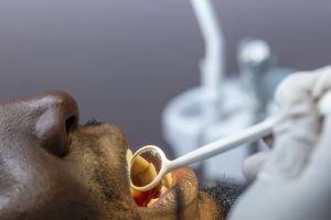 Non-invasive brush biopsy assay detects oral cancer in under an hour