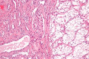 Targeted Therapies Dominate Renal Cancer Drug Pipeline Through 2026