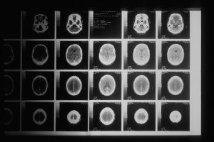 Alzheimer’s Research Breakthroughs Target Disease Progression in 2024