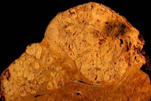 Researchers discover how rare liver cancer blocks immune attack with fibrous trap