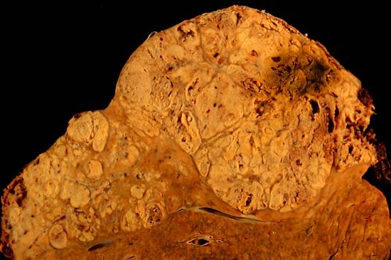 Researchers discover how rare liver cancer blocks immune attack with fibrous trap