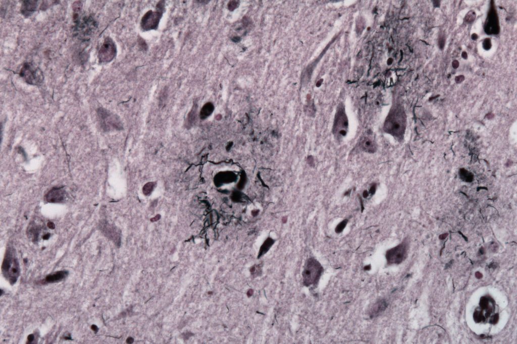 Alzheimers Amyloid Hypothesis Receives Strongest Clinical Validation Yet