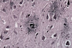 Alzheimer’s Amyloid Hypothesis Receives Strongest Clinical Validation Yet