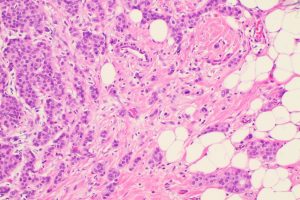 Medical Experts Outline Four-Step Treatment Sequence for Early Breast Cancer