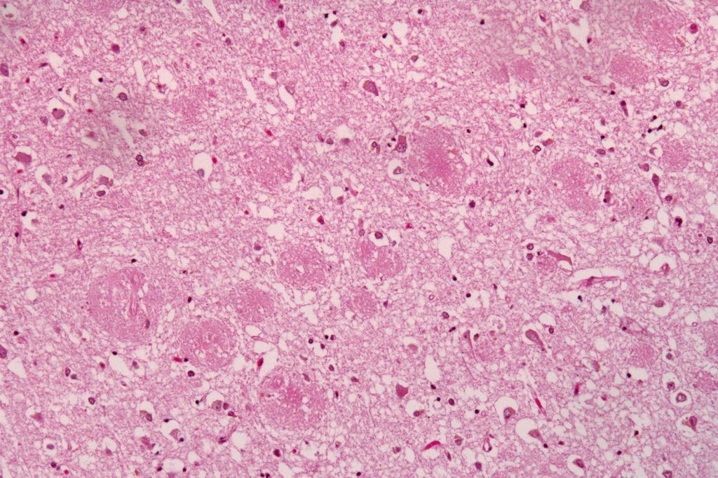 Alzheimers Research: From 1906 Discovery to Amyloid Hypothesis