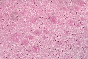 Alzheimer’s Research: From 1906 Discovery to Amyloid Hypothesis