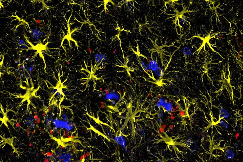 British Geneticist John Hardys Amyloid Hypothesis Shaped Alzheimers Research