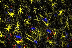 British Geneticist John Hardy’s Amyloid Hypothesis Shaped Alzheimer’s Research