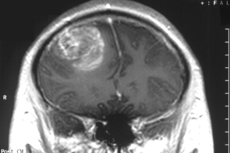 Modified B12 compound with nitric oxide targets glioblastoma in animal tests