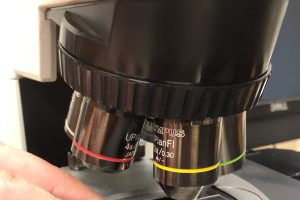 Melanoma’s genetic trick: Telomere extension drives unchecked tumor growth