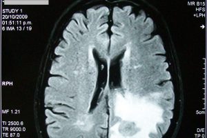 CAR-T Therapy Eradicates Brain Tumors in Preclinical Study