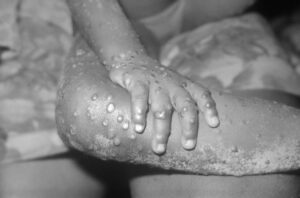 Gabon Reports First Mpox Case in Traveler from Uganda Recently
