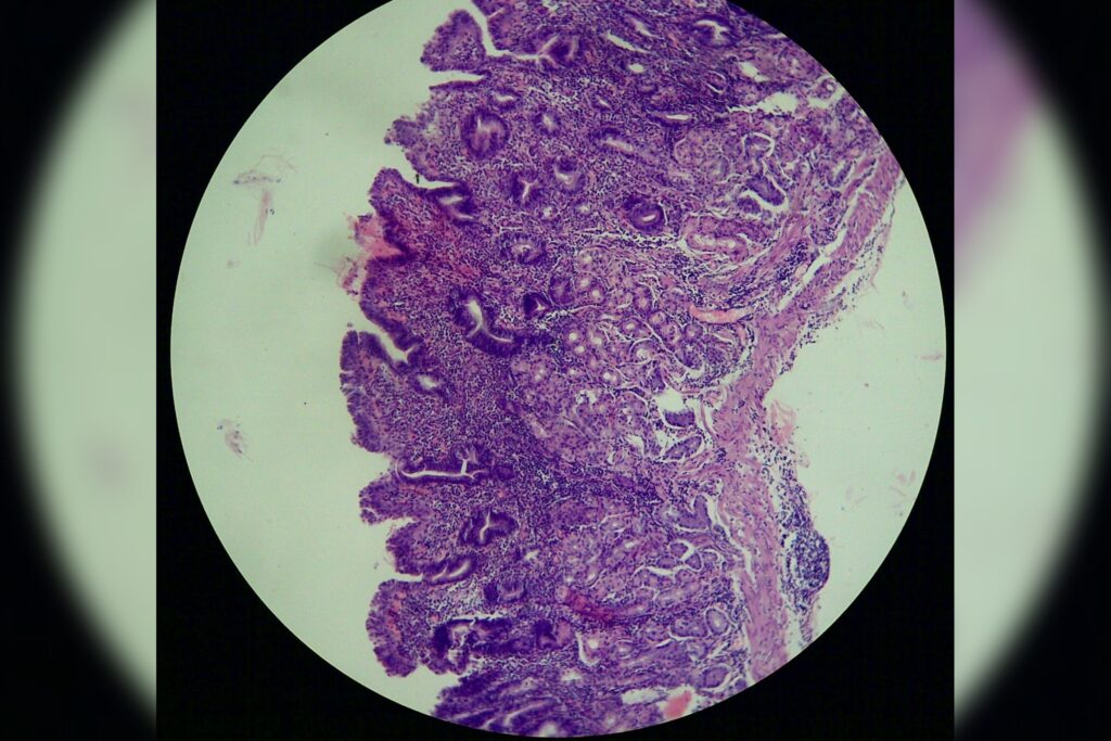 Autoimmune Gastritis