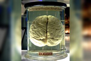 New Vitamin B12 Compound Breaks Blood-Brain Barrier to Target Glioblastoma
