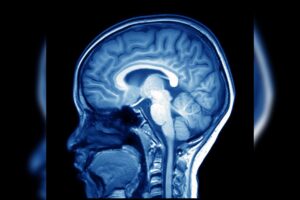 Brain Imaging Shows 8% Lower Choline in Anxiety Patients