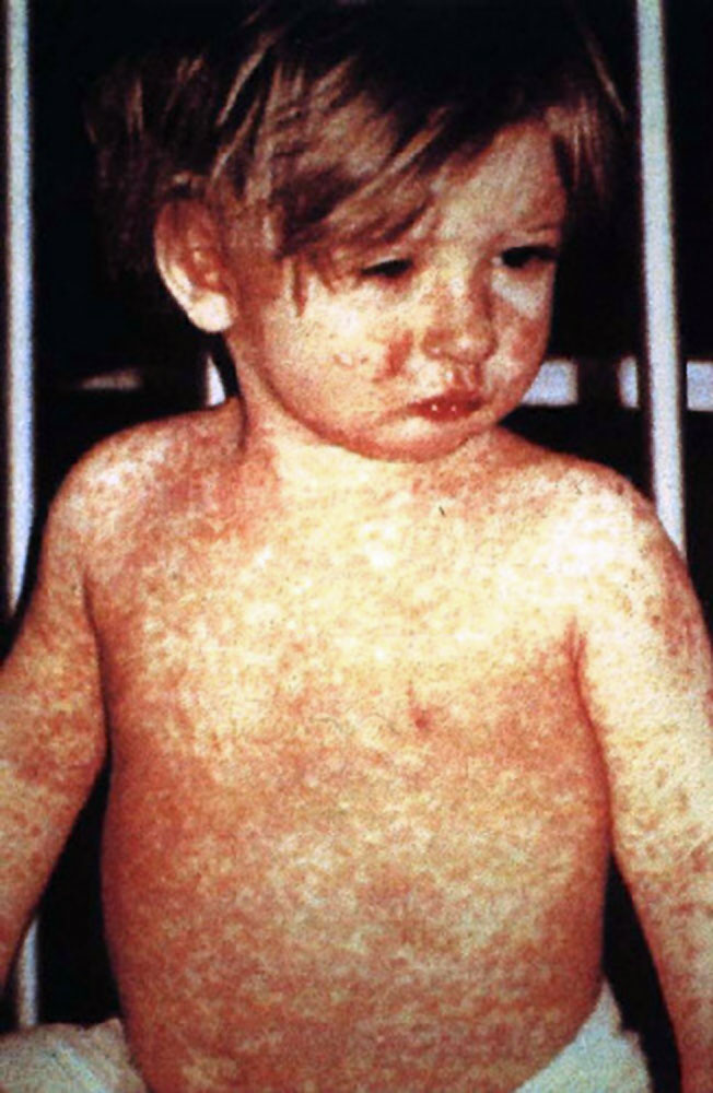 A doctor in a white coat administers a measles vaccine to a child in a clinic, with medical supplies visible on a nearby table.