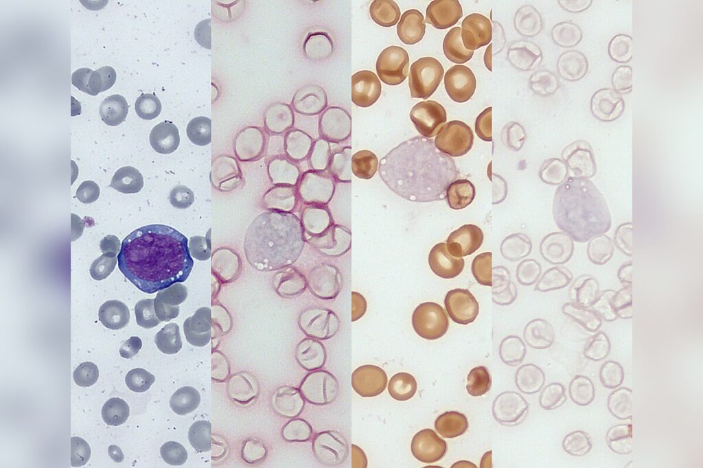 Leukemia
