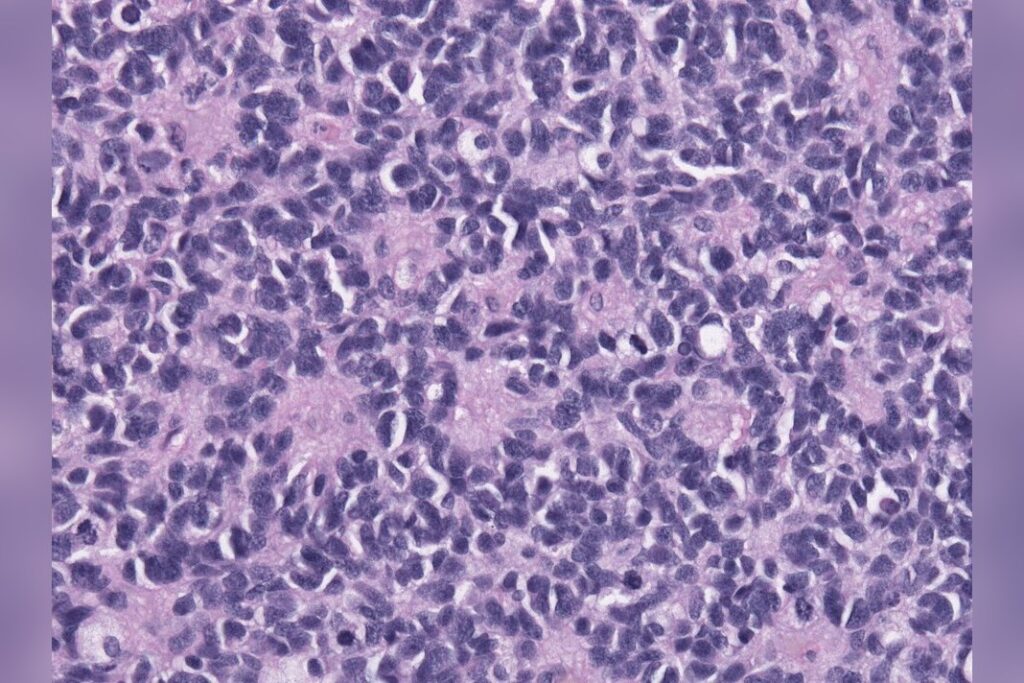 Medulloblastoma