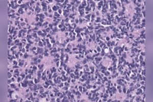 Father’s Hope Shattered as Rare Brain Cancer Returns