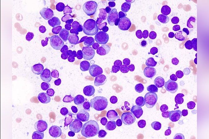 Multiple Myeloma Plasma Cells