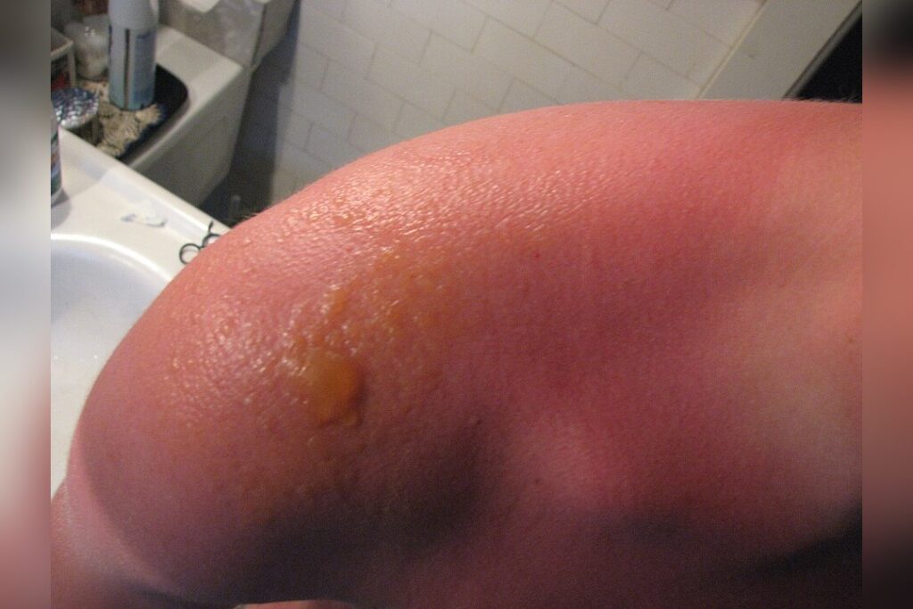 Severe Sunburn