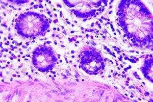 How a Hidden Fat-Sensing Protein Could Unlock Immunotherapy for Deadly Colorectal Cancers