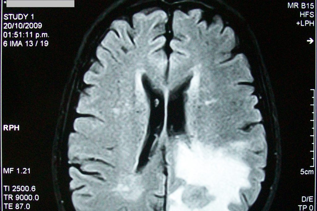 Publication of ROADS Phase 3 Trial Data Recommends GammaTile\u00ae as New Standard-of-Care for Brain Metastases