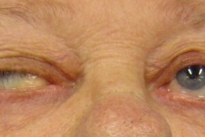 Generalized Myasthenia Gravis: Autoimmune Attack on Nerve-Muscle Junction Causes Progressive Weakness