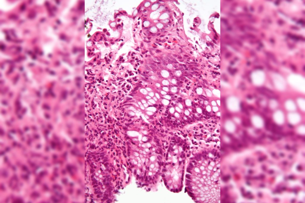 Ibd Microscope Image Of Inflammation