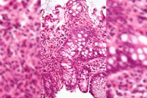 New study links diet to immune system attacks in bowel disease patients