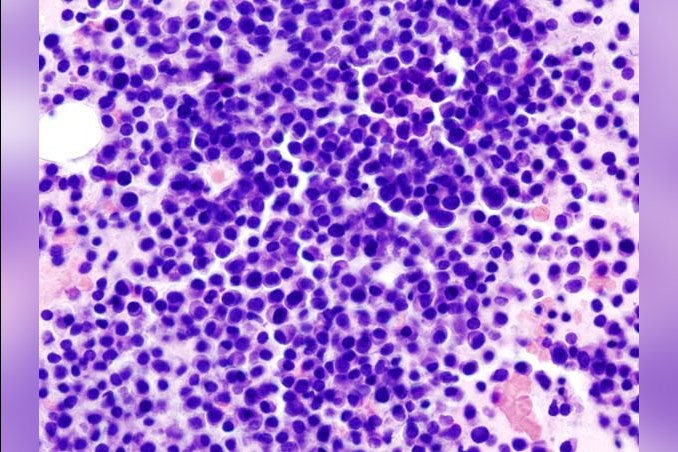 Multiple Myeloma